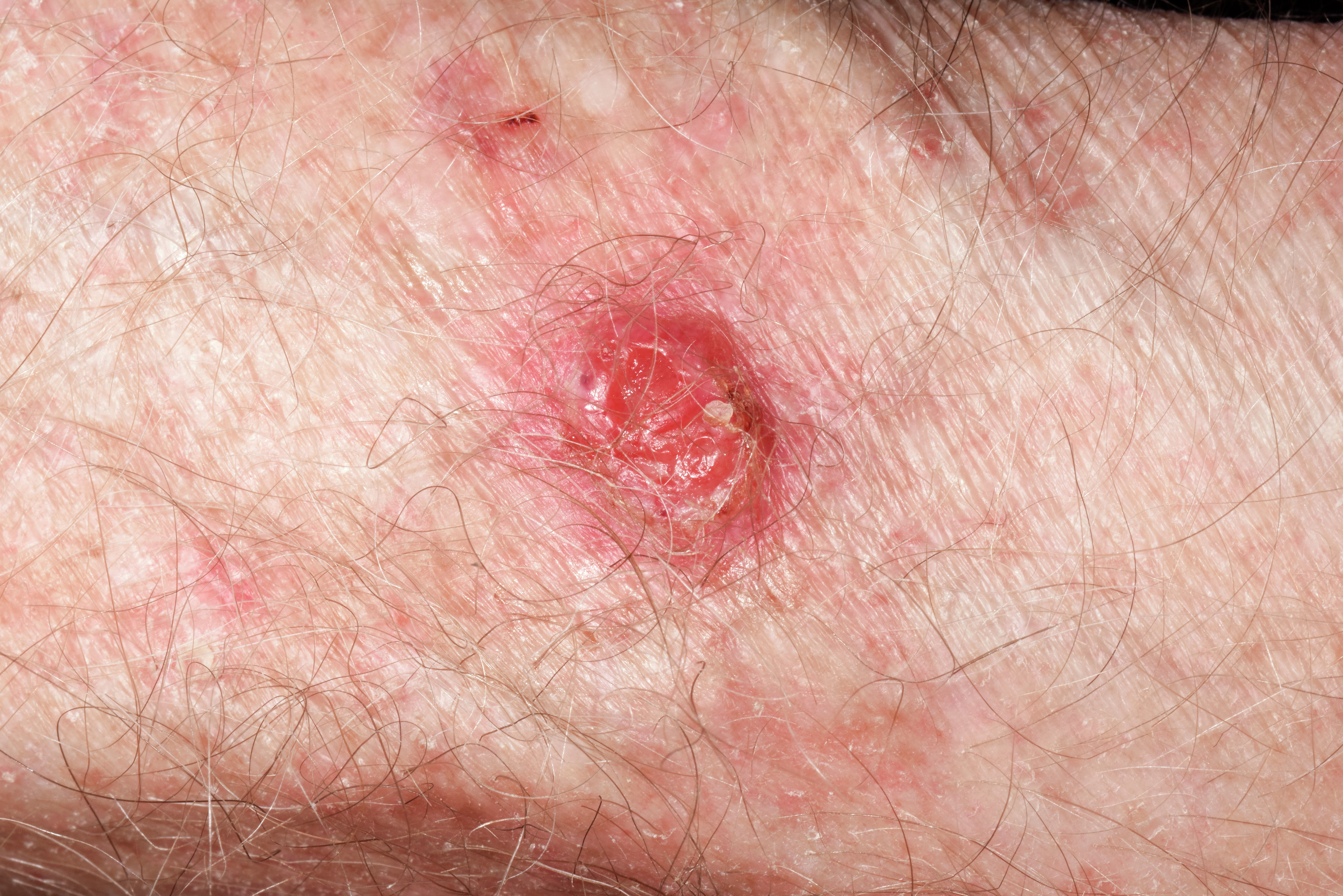 Berufskrankheit Hautkrebs.jpeg Berufskrankheit Hautkrebs